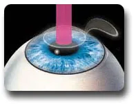 Digital illustration of an eye with a laser reshaping the cornea
