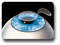 Digital illustration of an eye with a corneal flap